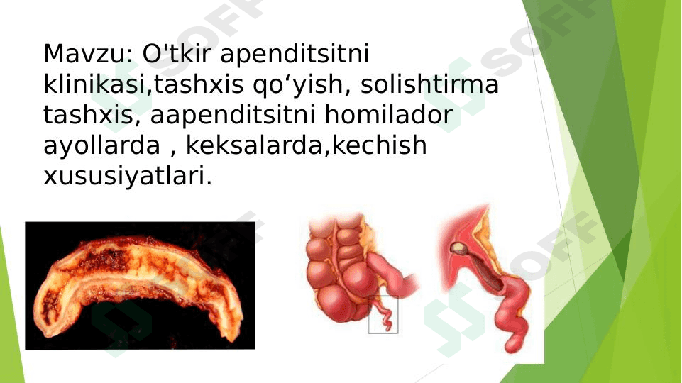 Oʻtkir apendisitni klinikasi 1
