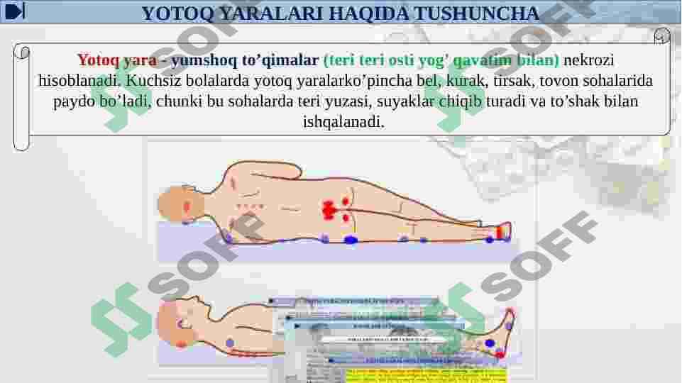 BEMORLARDA YOTOQ YARALARINI OLDINI OLISH 3