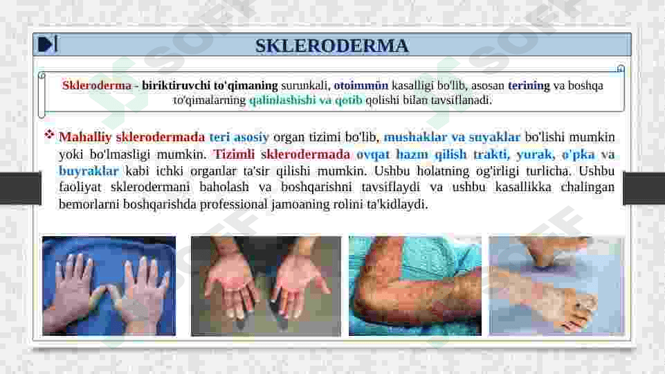 TIZIMLI SKLERODERMIYA 3