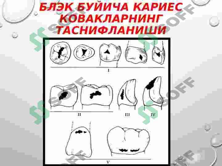 II СИНФ КАРИОЗ БЎШЛИҚЛАРИНИ ЧАРХЛАШ ВА ПЛОМБАЛАШ 3