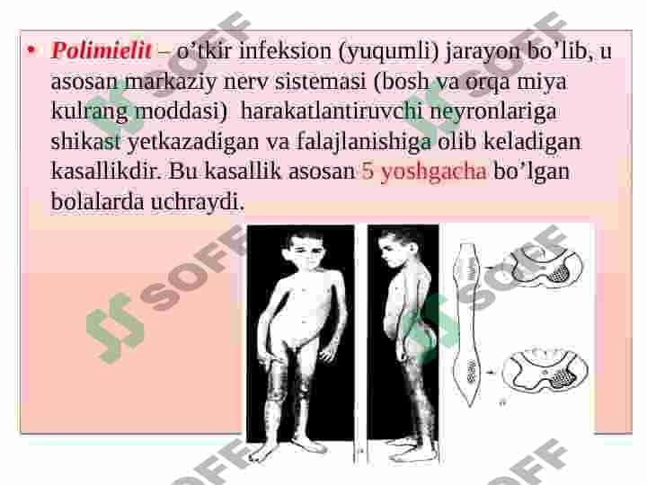 Polimielit kasalligi va uning bolalardagi xususiyatlari 3