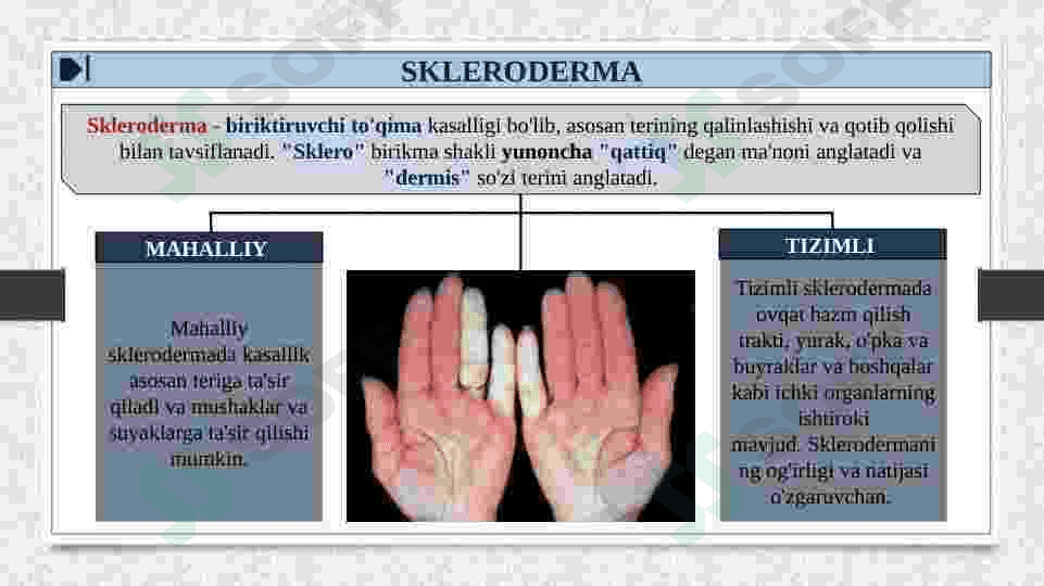 TIZIMLI SKLERODERMIYA 4