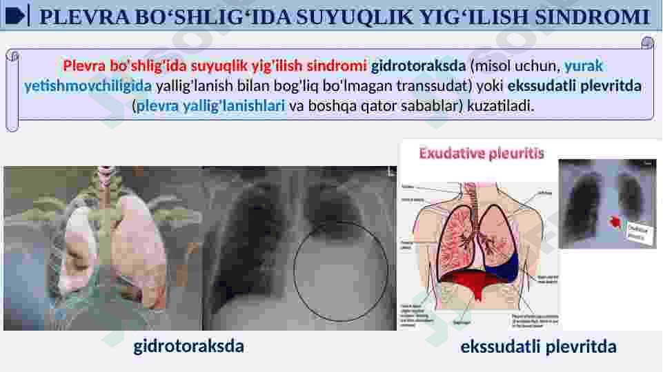 GIDROTORAKS. PNEVMOTORAKS. GEMOTORAKS 6