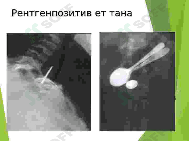 Ошкозон-ичак касалликларининг нур ташхиси 8