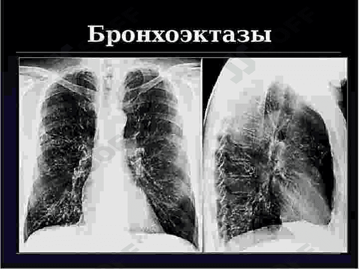 BRONXOEKTATIK KASALLIK 8