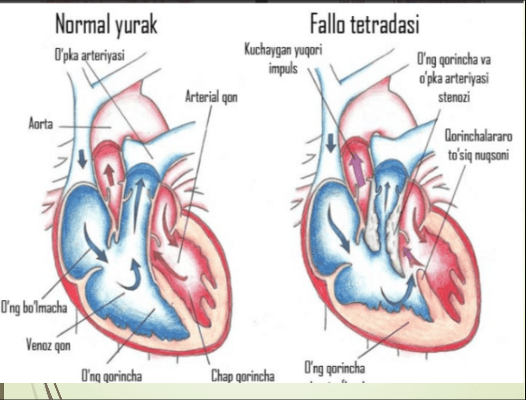 Bolalarda tug’ma yurak nuqsonlari klassifikatsiyasi 2