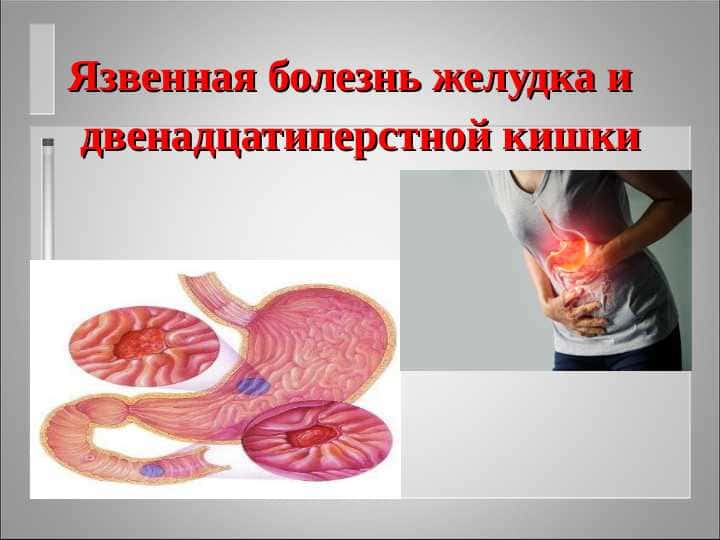 Язвенная болезнь желудка и  двенадцатиперстной
