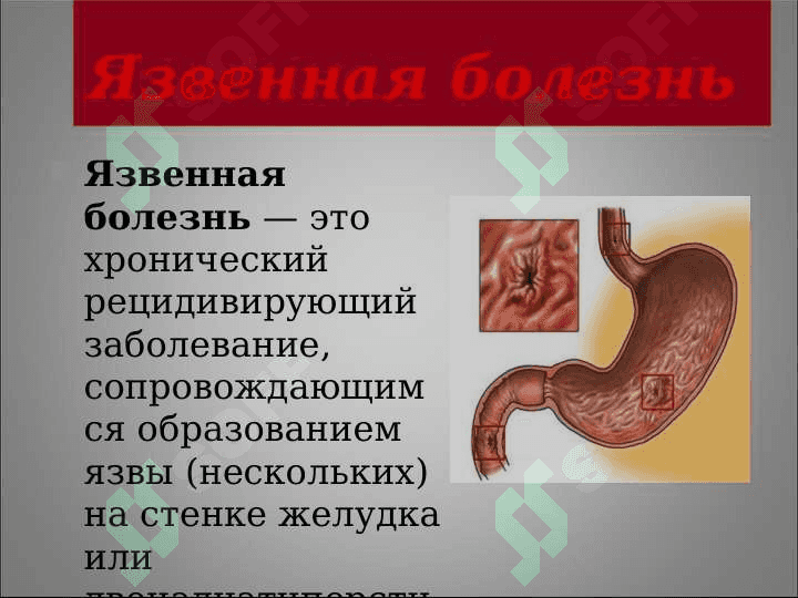 Язвенная болезнь желудка и  двенадцатиперстной 2