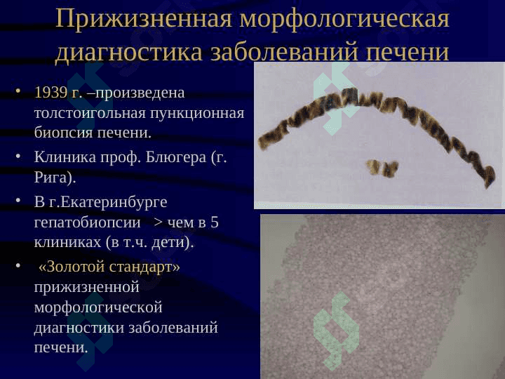 Болезни печени  Цирроз иопухоли печени 4