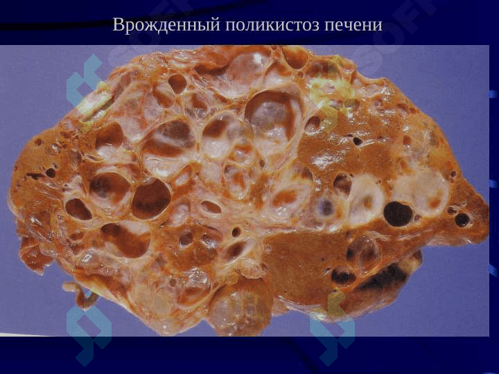 Болезни печени  Цирроз иопухоли печени 7