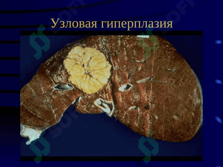 Болезни печени  Цирроз иопухоли печени 8