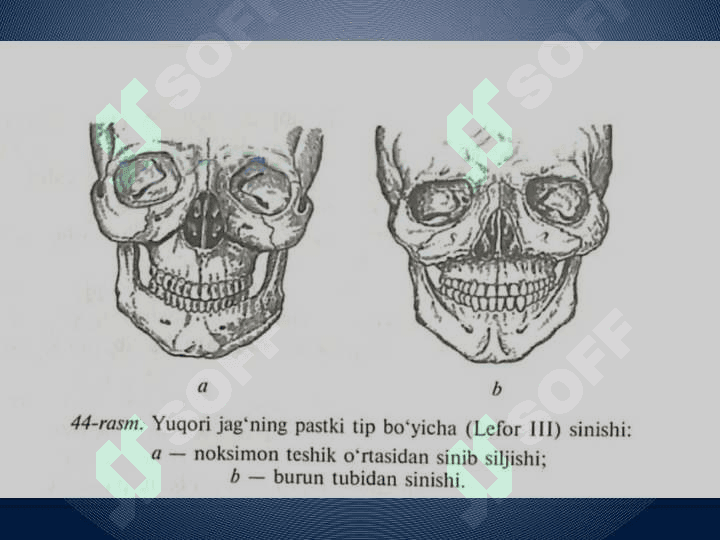 Bolalarda yuqori
 jag' sinishi 3