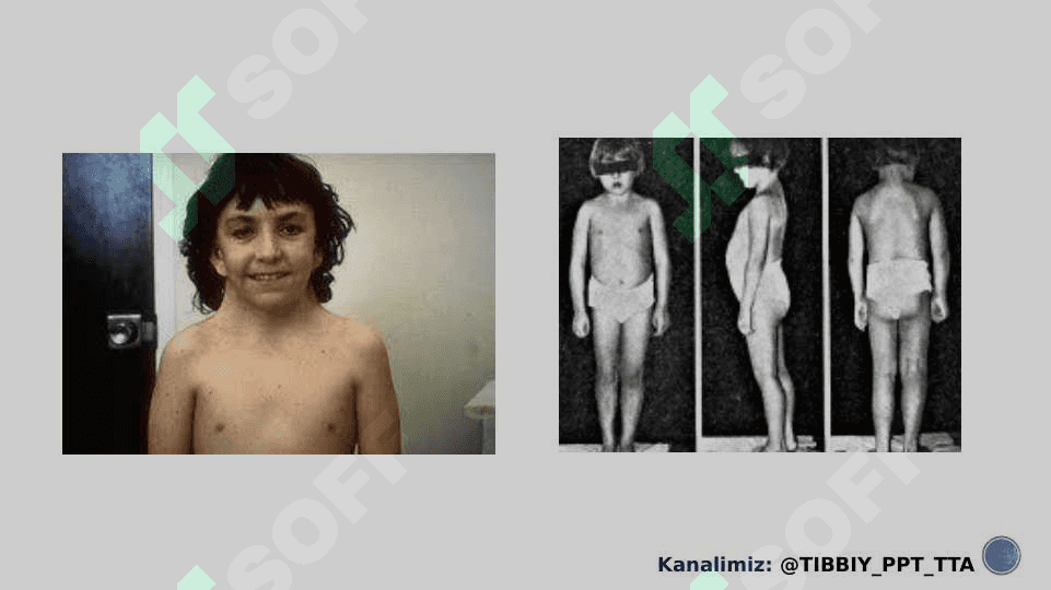 Shevshevskiy terner sindromi ppt 7