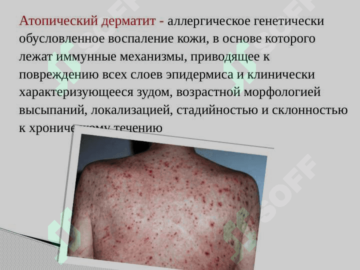 Atopik dermatit ppt 2