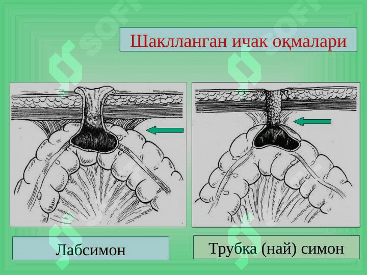 Ichak oqmalari ppt 6