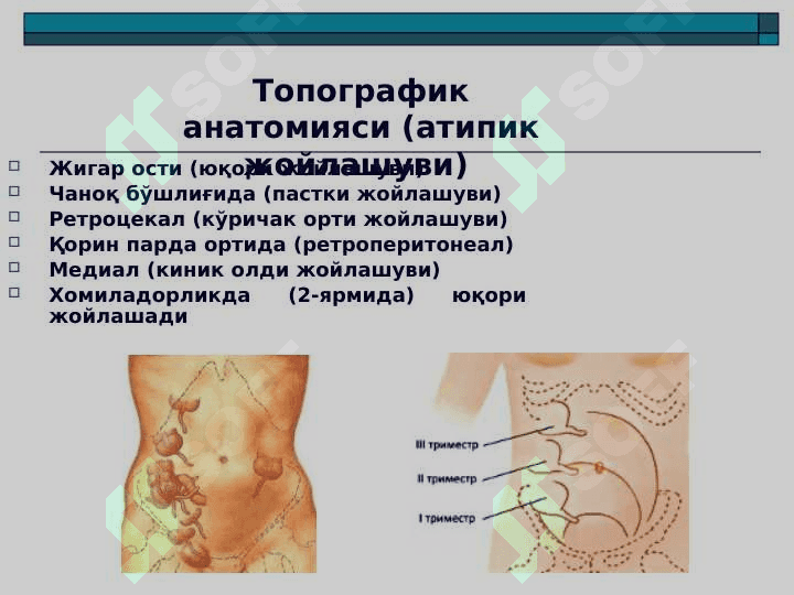O'tkir apenditsit ppt 4