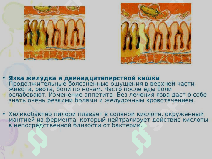 Гастритов и язвенная болезнь 5
