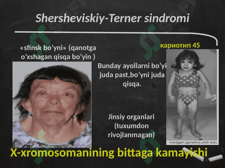 Odamda uchraydigan irsiy kasalliklar 7