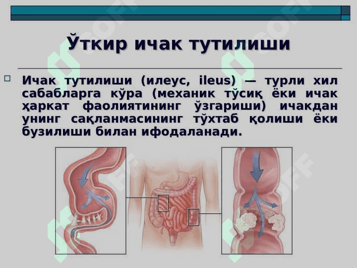 O`tkir ichak tutilishi . Уткир ичак тутилиши 2
