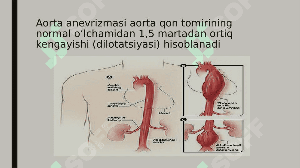 Aorta 
anevrizmasi 2