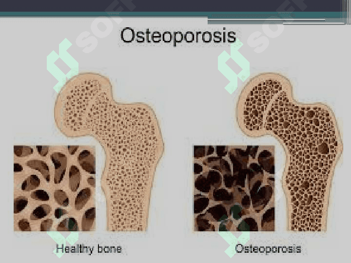 OSTEOPAROZ/ OSTEOPAROSIS 4
