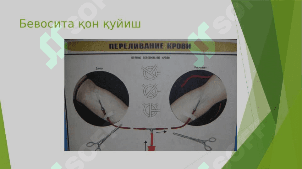 Qon quyish usullari 3