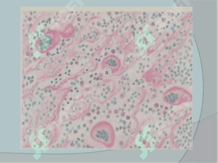 Immunopatalogik jarayonlar.immunogenez buzilish morfologiyasi 7