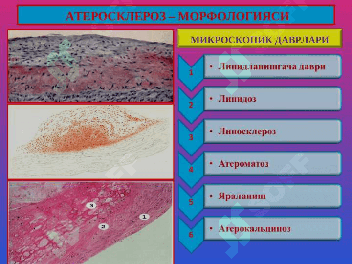 Атеросклероз. Гипертония касаллиги 7