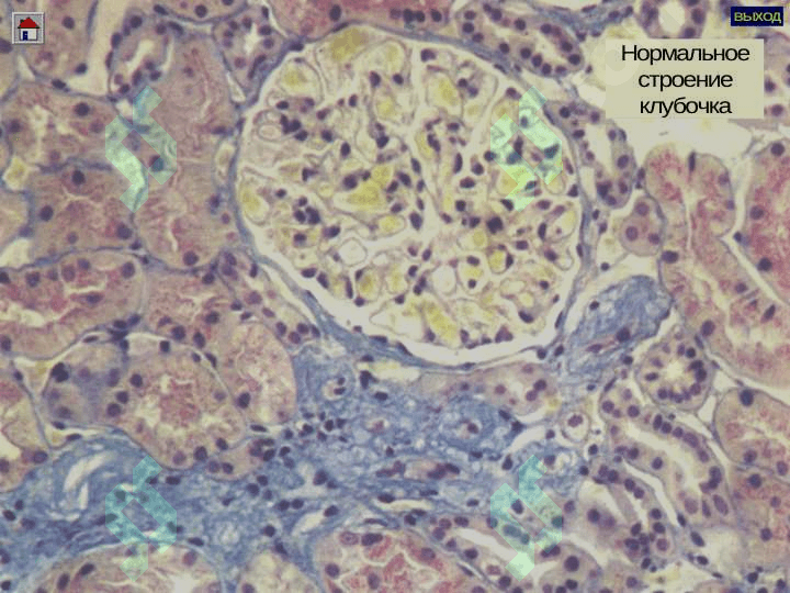 Glomerulonefritlar va Pielonefritlar 5