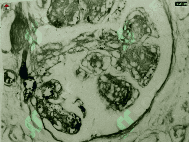 Glomerulonefritlar va Pielonefritlar 8