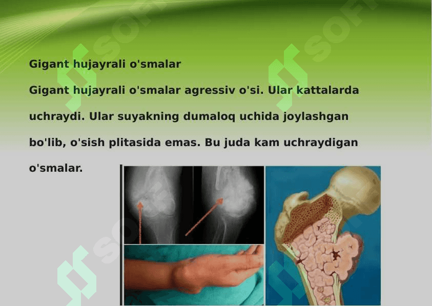 Suyak to‘qimasi o‘smasi 7