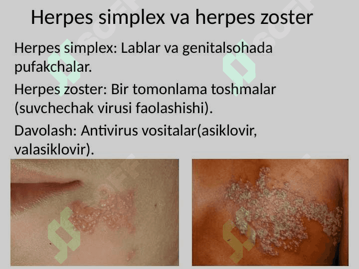 OITSda_Teri_Kasalliklari_Taqdimoti 7