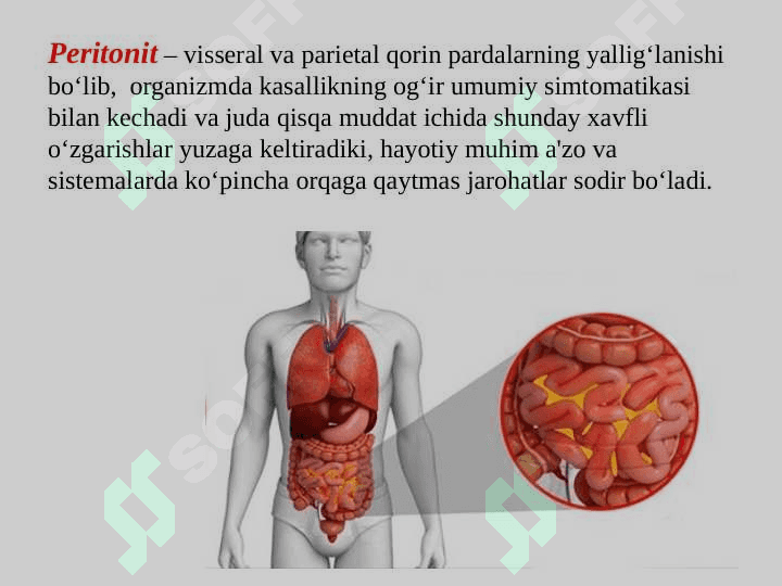 Oʻtkir yiringli peritonit 2