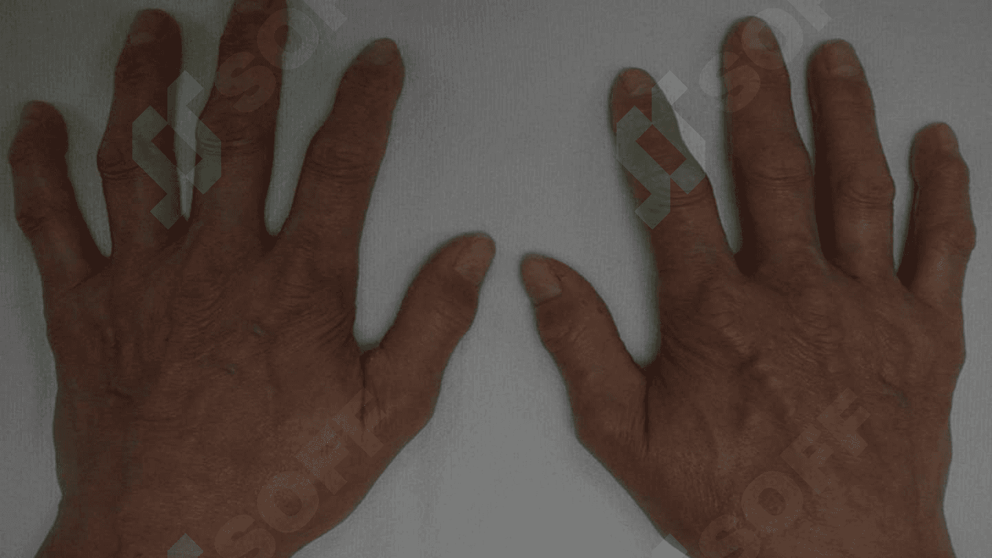 SKLERODERMIYA.DERMATOMIOZIT 4