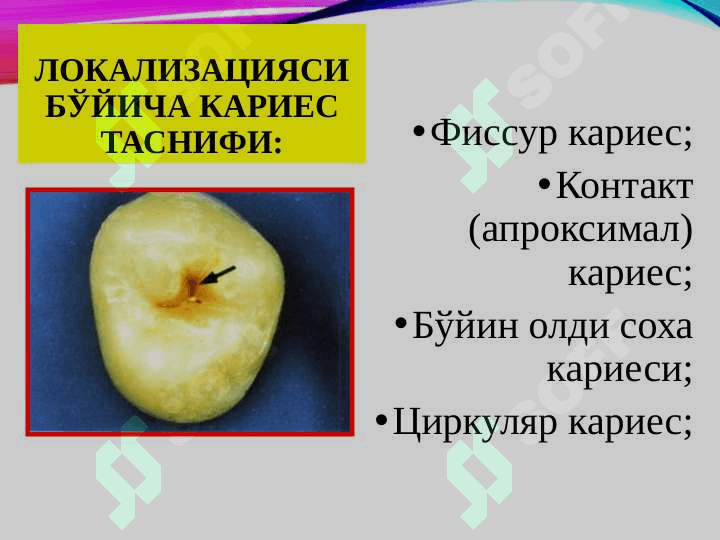 TISHKARIESNI  TASHXISLASH VA DAVOLASH 3