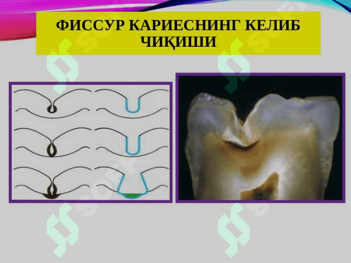 TISHKARIESNI  TASHXISLASH VA DAVOLASH 4