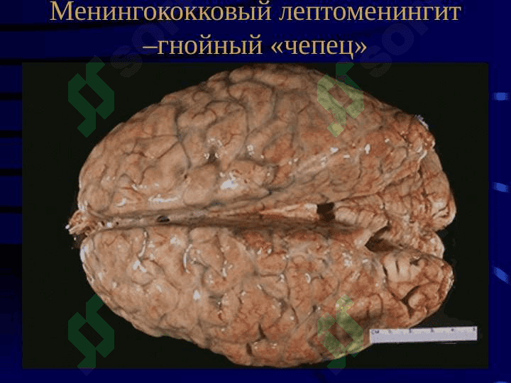 Менингококковая инфекция 5