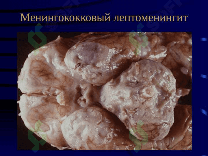Менингококковая инфекция 6