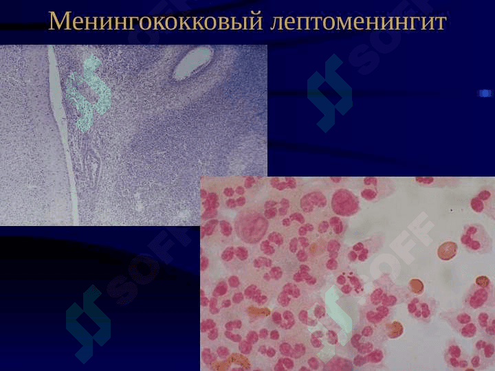 Менингококковая инфекция 7