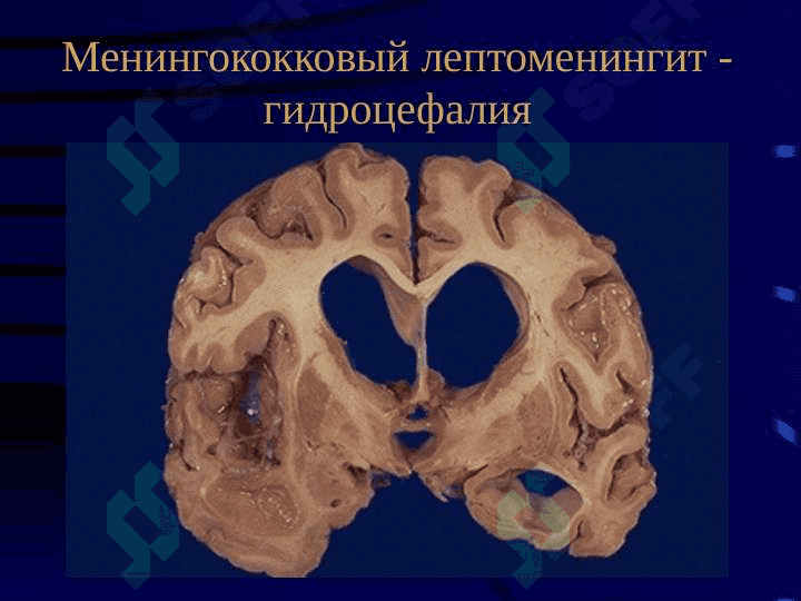 Менингококковая инфекция 8