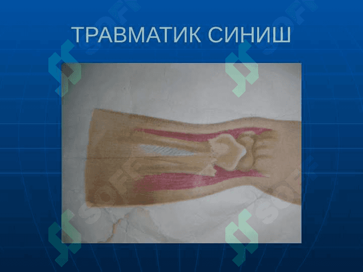 Суякларнинг синиши ва чикиши. 8
