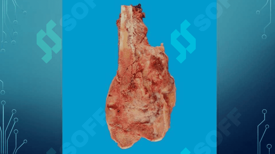 Osteosarkoma 3