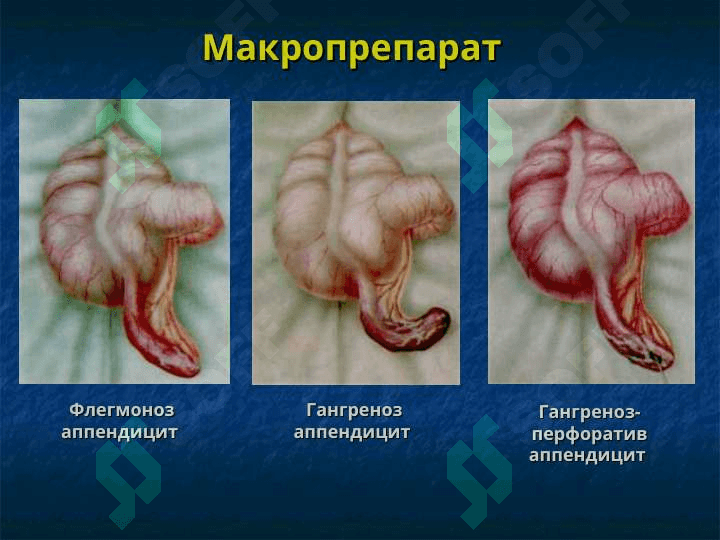Болаларда ўткир қорин синдроми 6