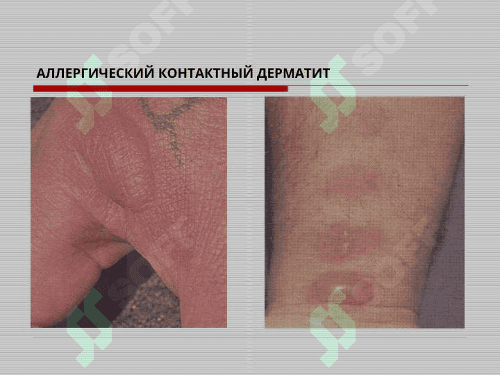 Аллерго ва нейродерматозлар 3
