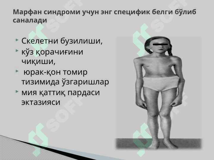 Marfan Sindromi . Марфан синдроми 5