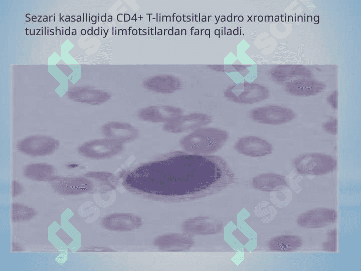 Sezari sindromi (teri limfotsitomasi) 4