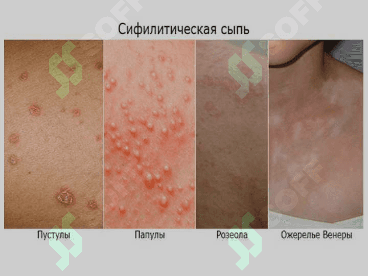 ZAXM KASALLIGI. ZAXM DIAGNOSTIKASI 7