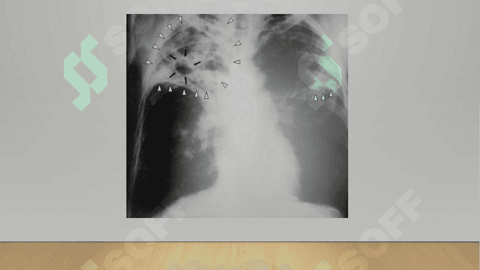 Tuberkulyoz (TB) etiologiyasi va dorilarga chidamli turlari 6