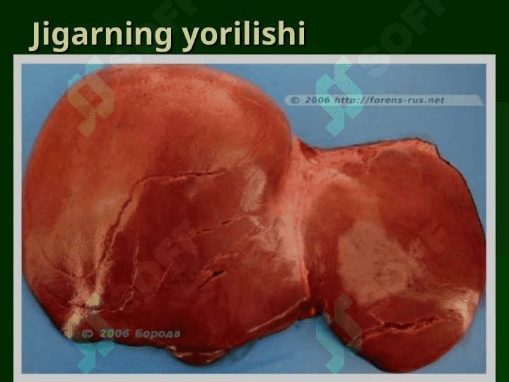 QORIN BO’SHLIG’I AZOLARINING YOPIQ SHIKASTLANISHLARI 5