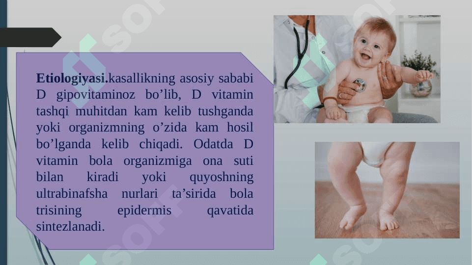 Bolalarda raxit 3